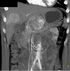 Metastatic Islet Cell Tumor - CTisus CT Scan