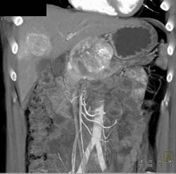 Metastatic Islet Cell Tumor - CTisus CT Scan