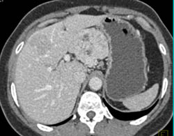 Metastatic Islet Cell Tumor - CTisus CT Scan