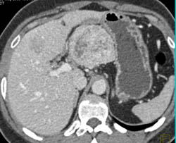 Metastatic Islet Cell Tumor - CTisus CT Scan