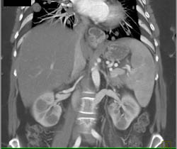 Metastatic Pancreatic Cancer to the Kidneys - CTisus CT Scan