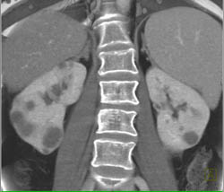 Carcinoma in Tail of Pancreas - CTisus CT Scan