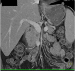 Intraductal Papillary Mucinous Neoplasms (IPMNs) in Head of Pancreas - CTisus CT Scan