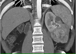 Intraductal Papillary Mucinous Neoplasms (IPMNs) Plus Renal Cell Carcinoma - CTisus CT Scan