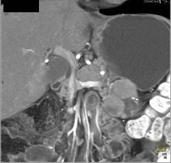 Carcinoma Off Tail of Pancreas - CTisus CT Scan