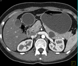 Intraductal Papillary Mucinous Neoplasm (IPMN) - CTisus CT Scan