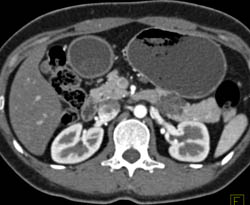 Intraductal Papillary Mucinous Neoplasm (IPMN) - CTisus CT Scan