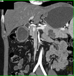 Intraductal Papillary Mucinous Neoplasm (IPMN) - CTisus CT Scan