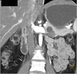 Intraductal Papillary Mucinous Neoplasm (IPMN) - CTisus CT Scan