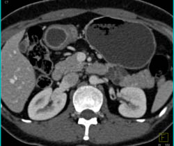 Intraductal Papillary Mucinous Neoplasm (IPMN) - CTisus CT Scan