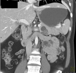 Intraductal Papillary Mucinous Neoplasm (IPMN) - CTisus CT Scan