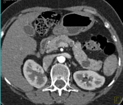 Intraductal Papillary Mucinous Neoplasm (IPMN) - CTisus CT Scan