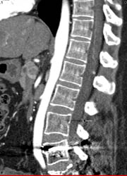 Intraductal Papillary Mucinous Neoplasm (IPMN) - CTisus CT Scan