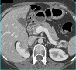 Intraductal Papillary Mucinous Neoplasm (IPMN) - CTisus CT Scan