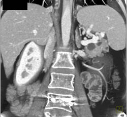 Intraductal Papillary Mucinous Neoplasm (IPMN) - CTisus CT Scan