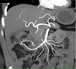 Nice Mesenteric Arcade - CTisus CT Scan