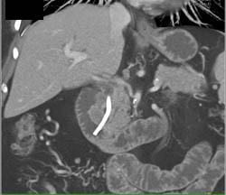 Ampullary Carcinoma - CTisus CT Scan