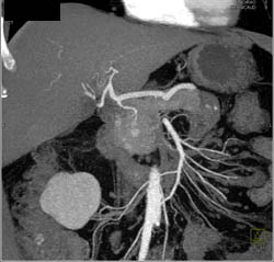 Metastatic Renal Cell to Pancreatic Head - CTisus CT Scan