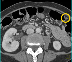 Pancreatic Cancer With Omental Implants - CTisus CT Scan