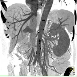 Tumor Encases Renal Vein With Large Collaterals - CTisus CT Scan