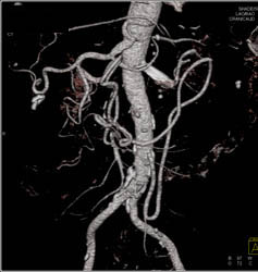 Collaterals Through the Ima in Patient for Occluded Celiac Artery at Origin - CTisus CT Scan