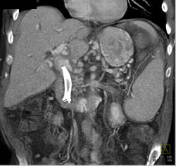 Pancreatic Cancer With Cavernous Transformation of the Portal Vein (CTPV) - CTisus CT Scan