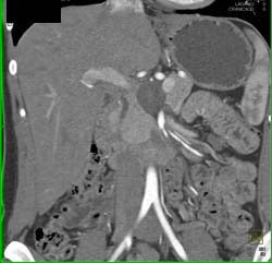 Neurogenic Tumor Near Pancreas - CTisus CT Scan