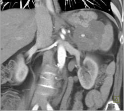 Pancreatic Cancer Invades the Spleen - CTisus CT Scan