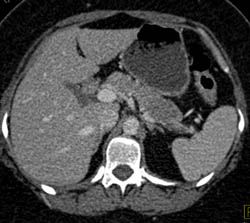 Pancreatic Cancer Is Diffusely Infiltrating - CTisus CT Scan