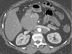 Unusual Hypovascular Non Functioning Islet Cell Tumor - CTisus CT Scan