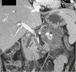 Ulcerating Mass Involves Tail of Pancreas - CTisus CT Scan