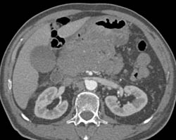 Islet Cell Tumor - CTisus CT Scan