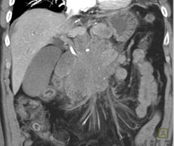 Islet Cell Tumor - CTisus CT Scan