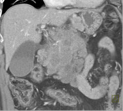 Islet Cell Tumor - CTisus CT Scan