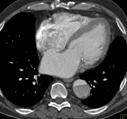 Pancreatic Cancer Detected During Aortic Dissection Workup - CTisus CT Scan