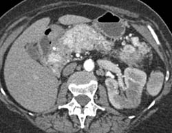 Islet Cell Tumor- Diffuse - CTisus CT Scan