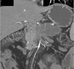 Pancreatic Cancer - CTisus CT Scan