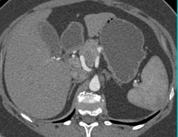 Neurogenic Tumor Near Pancreas- Off Body - CTisus CT Scan