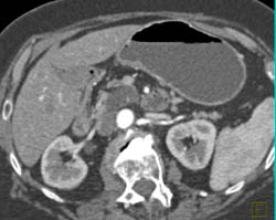 Intraductal Papillary Mucinous Neoplasm (IPMN) - CTisus CT Scan