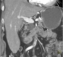 Intraductal Papillary Mucinous Neoplasm (IPMN) - CTisus CT Scan