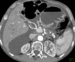 Carcinoma in Tail of Pancreas With Encasement - CTisus CT Scan