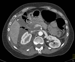 Acute Pancreatitis With Perforation S/P ERCP - CTisus CT Scan