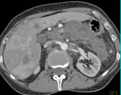 Carcinoma Tail of Pancreas With Liver Metastases - CTisus CT Scan