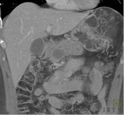 Adenocarcinoma of the Pancreas Head - CTisus CT Scan