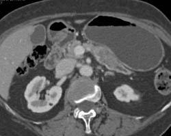 Pancreatic Cancer Arises in An Intraductal Papillary Mucinous Neoplasm (IPMN) - CTisus CT Scan