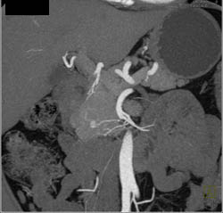 6mm Insulinoma in the Head of the Pancreas - CTisus CT Scan