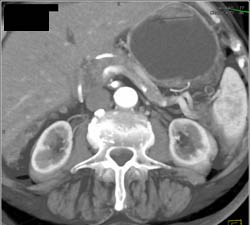 Islet Cell Tumor Less Than 1cm in Tail of the Pancreas - CTisus CT Scan