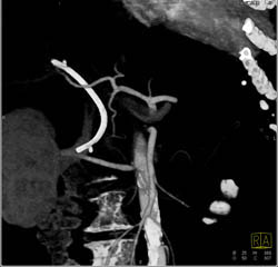 Pancreatic Cancer With Dilated Pancreatic Duct - CTisus CT Scan