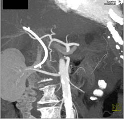 Pancreatic Cancer With Dilated Pancreatic Duct - CTisus CT Scan