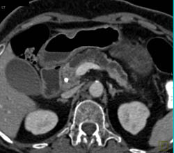 Pancreatic Cancer With Dilated Pancreatic Duct - CTisus CT Scan